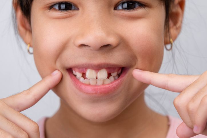 Smiling child pointing to a gap in their front teeth on a light background