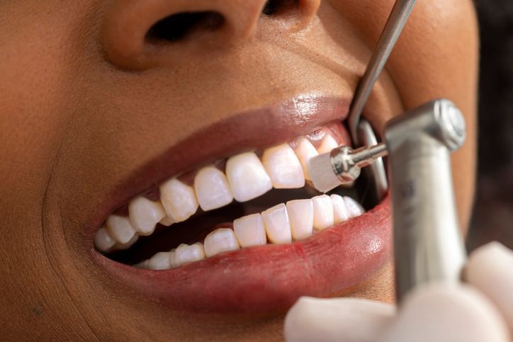 Dental cleaning with a drill on a person’s teeth, close-up view