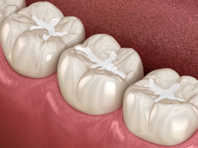 Close-up of three white molar teeth with dental fillings on pink gums, or dental model.