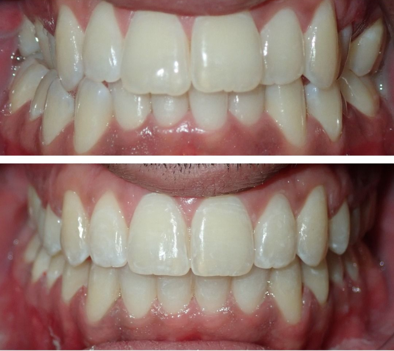 Before-and-after close-up of teeth and gums, showing improved alignment and brightness.