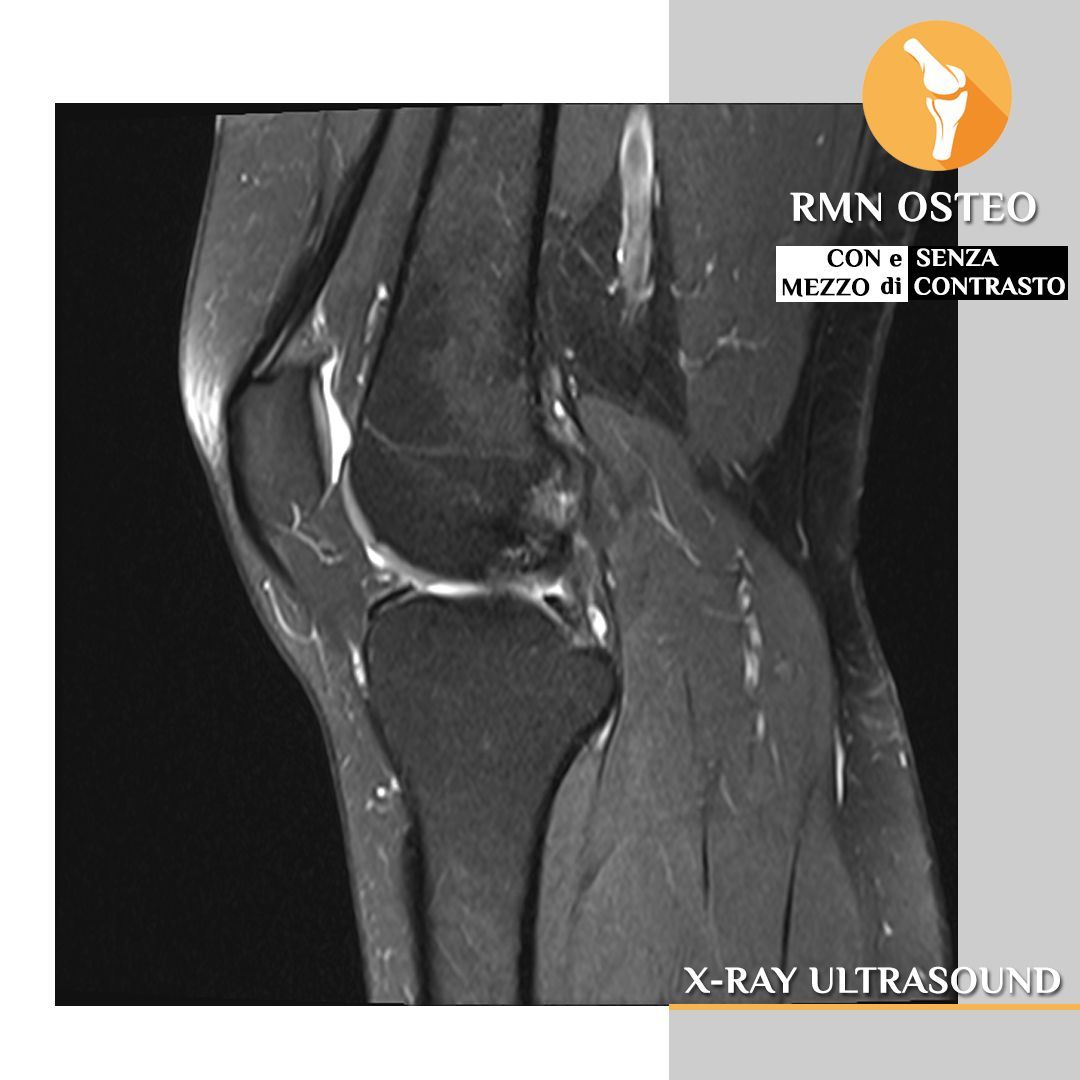RMN Osteo