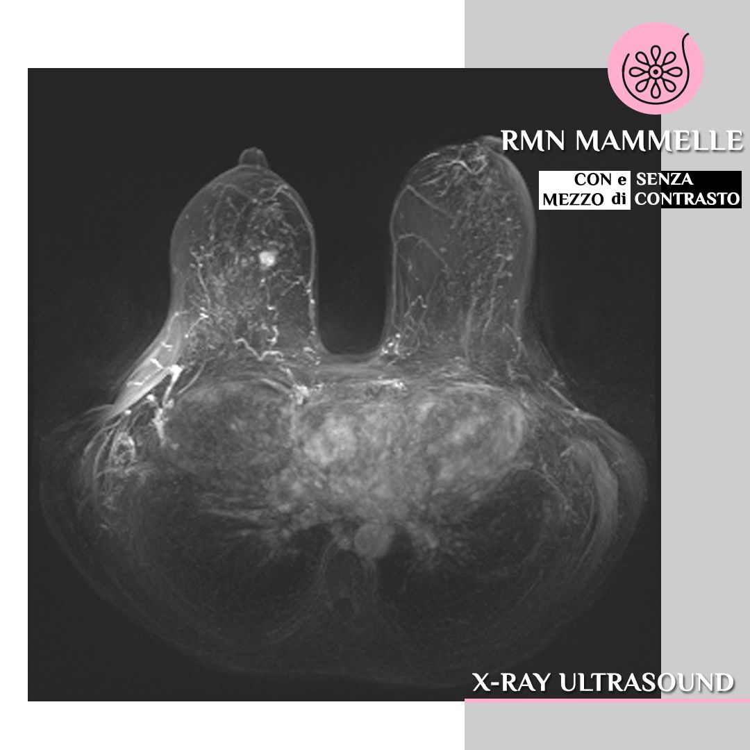 RMN Mammella
