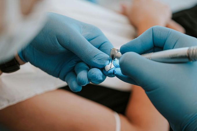 Mani guantate di un dentista che impugna uno strumento odontoiatrico mentre lavora su un piccolo dente o un'otturazione, con il paziente sullo sfondo.