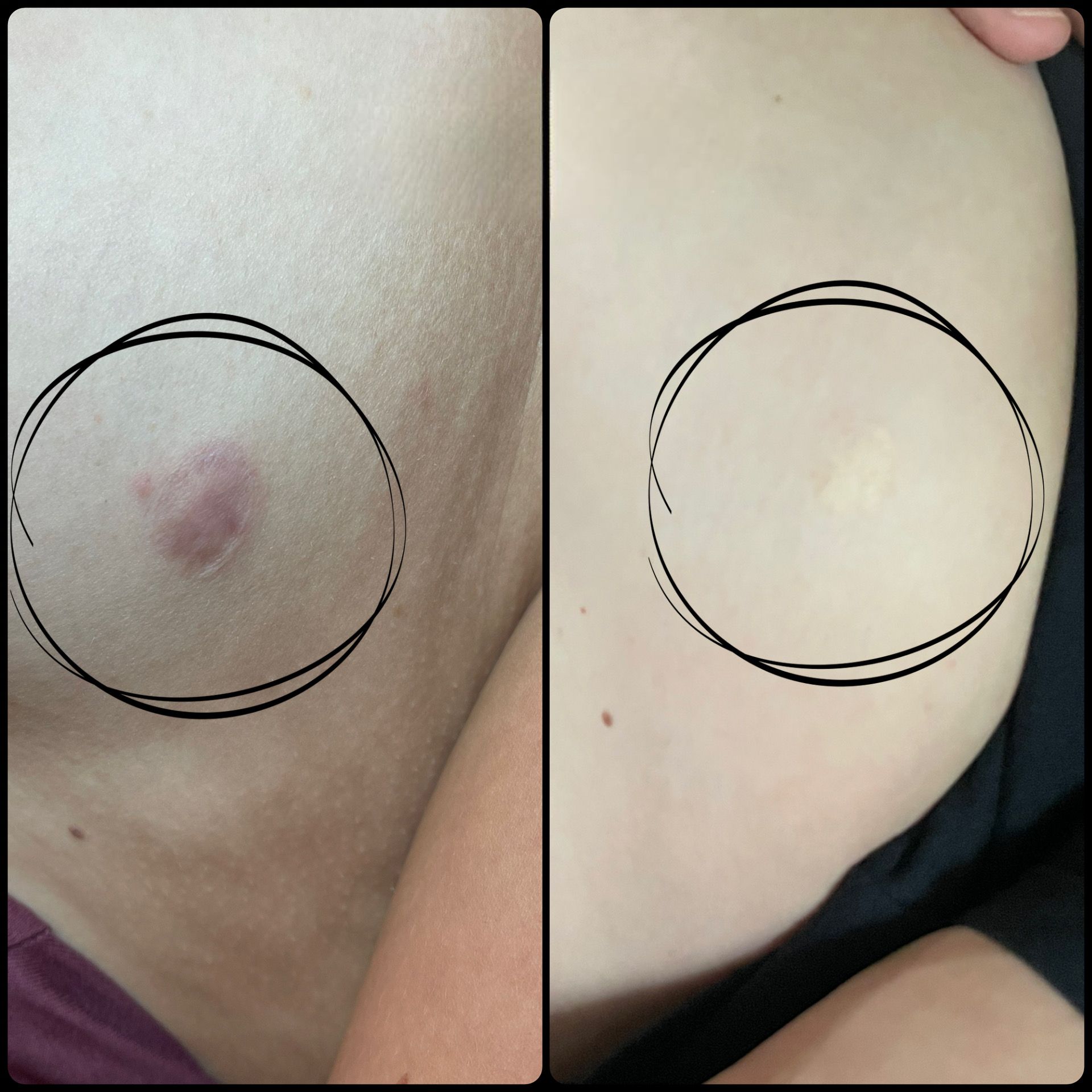 Side-by-side skin close-ups showing a red bruise on one and a faint mark on the other, both circled in black.