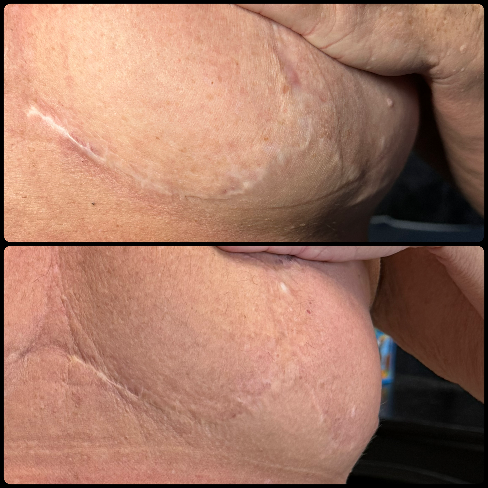 Close-up of a skin fold on an arm showing a thin white scar.