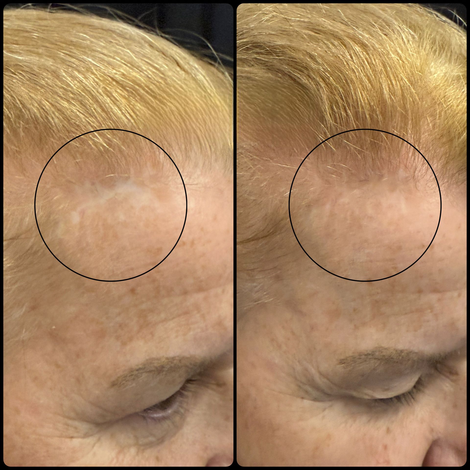 Side-by-side close-up of forehead skin before and after treatment, with a circled area highlighting texture changes