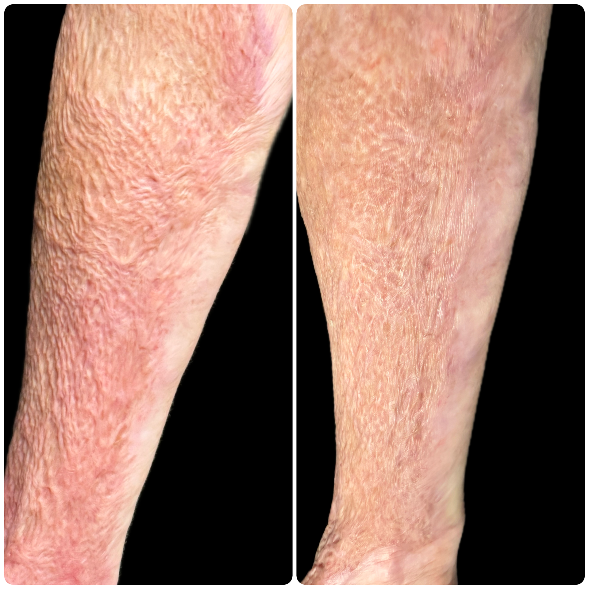 Side-by-side close-up of two lower legs with dry, rough, reddish skin texture