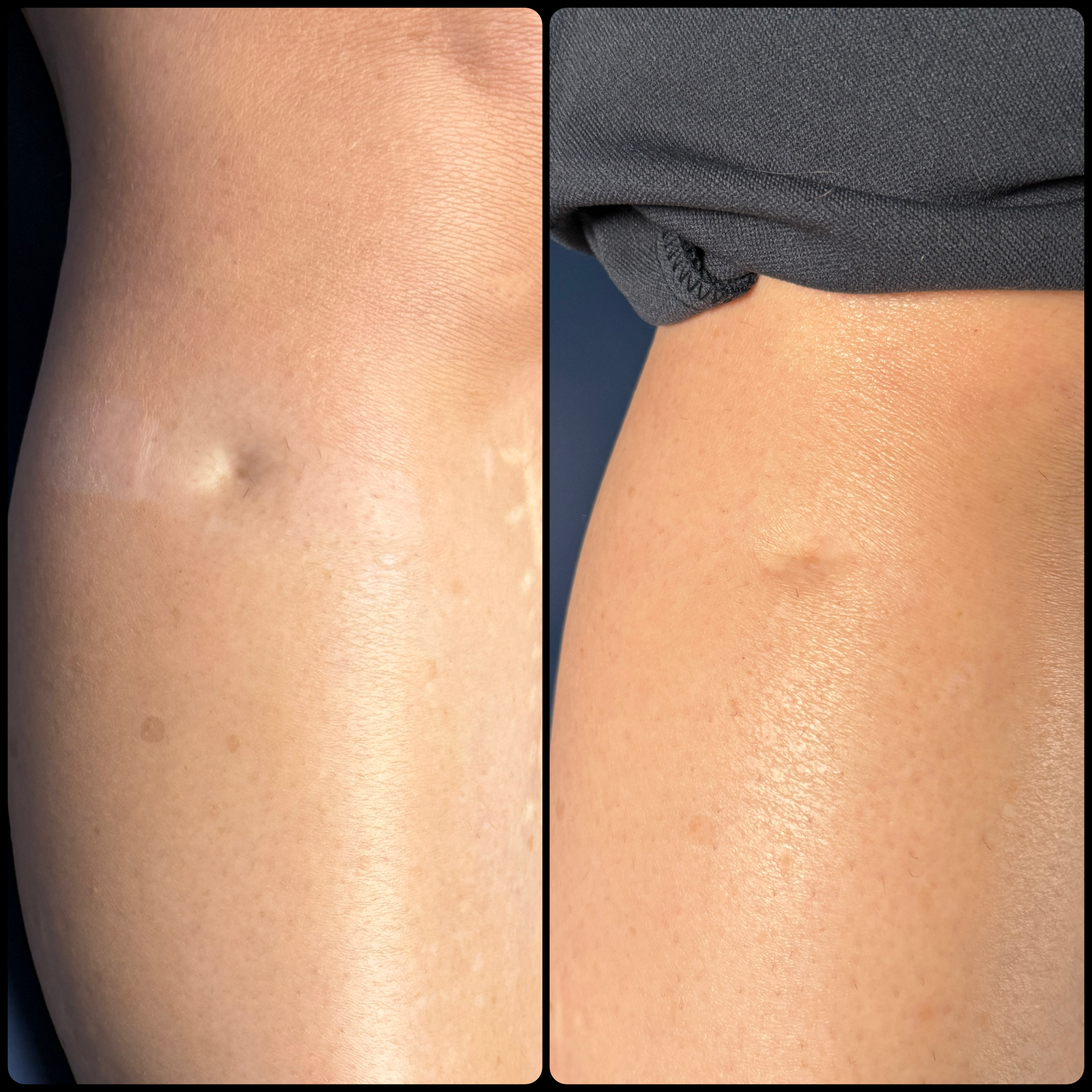Close-up of a person's torso showing two small abdominal dimples, one on each side.