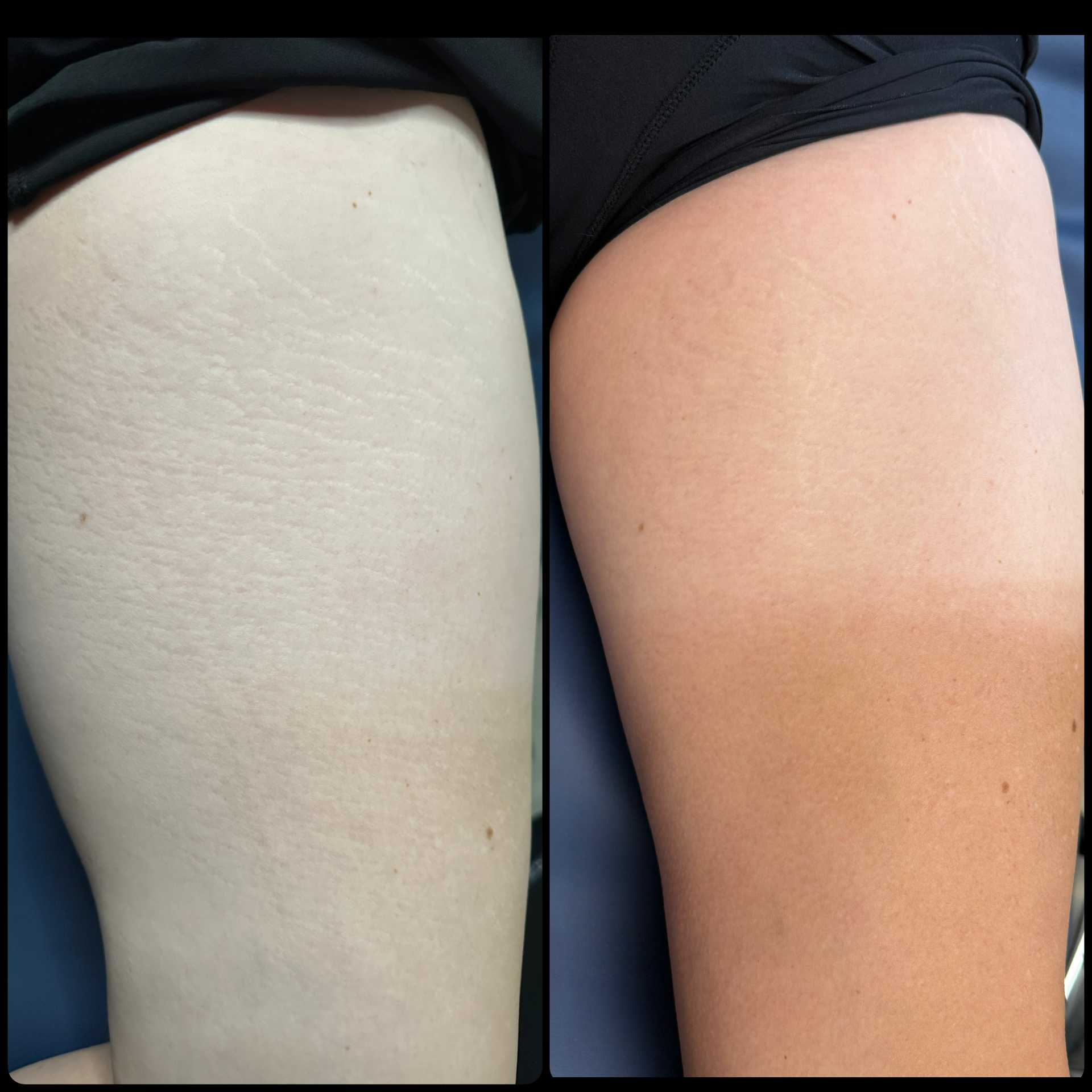 Side-by-side close-up of a leg skin before and after tanning, showing lighter and darker tones