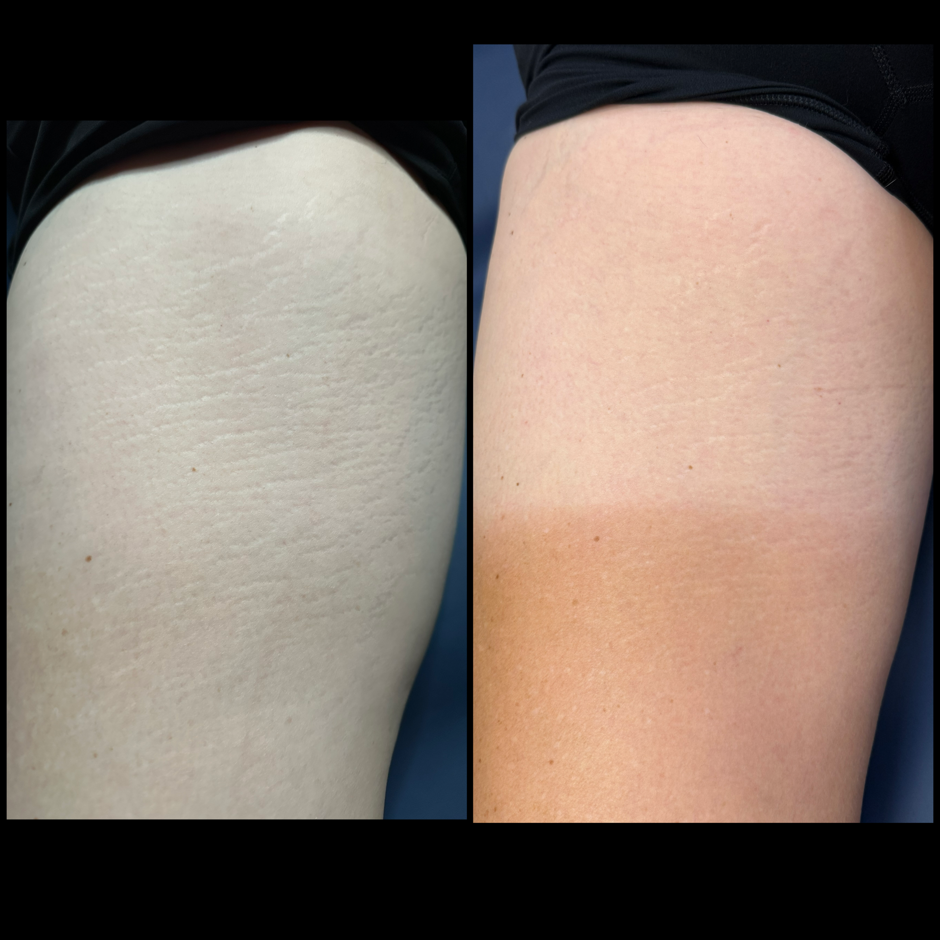 Side-by-side close-up of skin showing a pale area and a tanned area on a thigh.