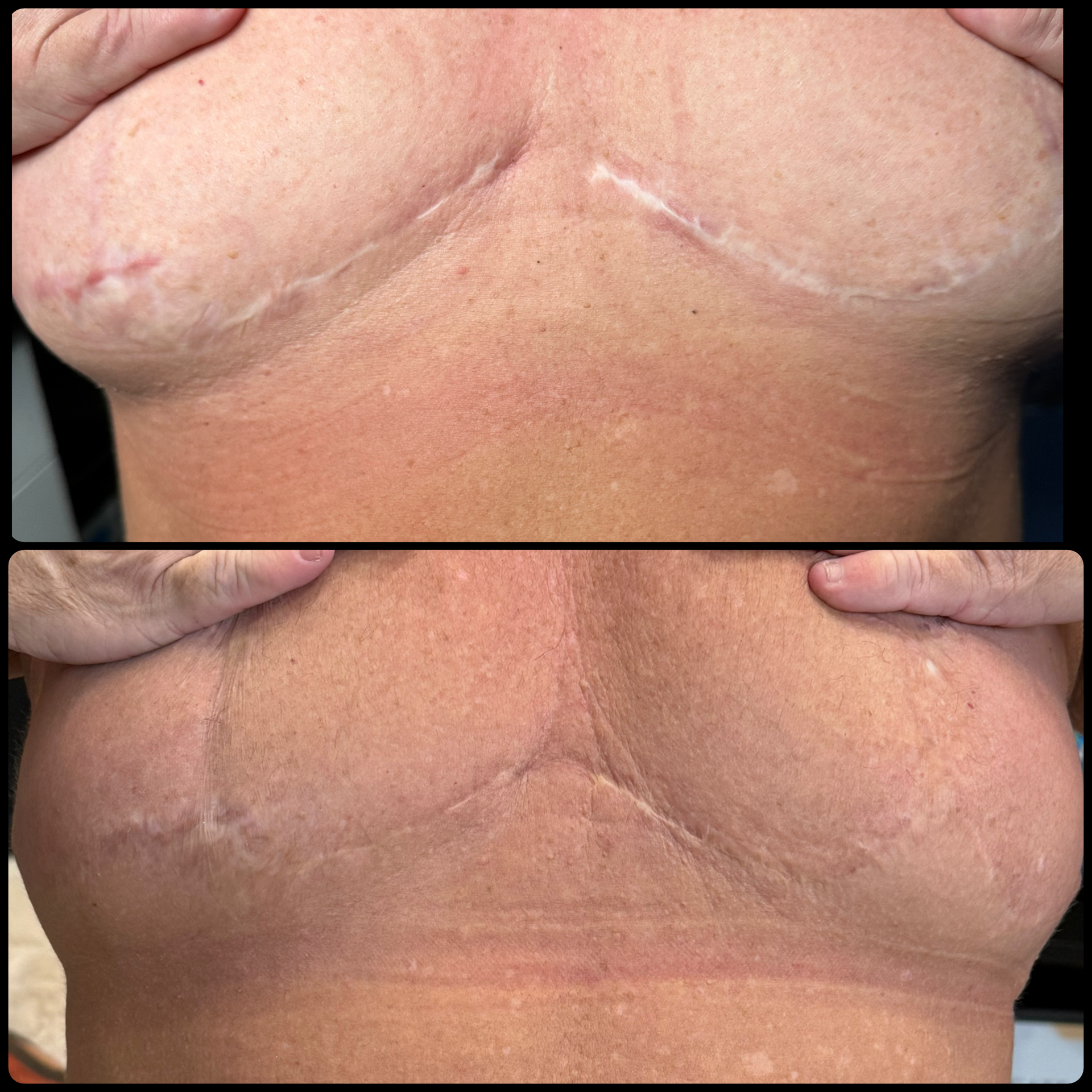 Two stacked photos of a torso showing a pale surgical scar across the chest and abdomen.