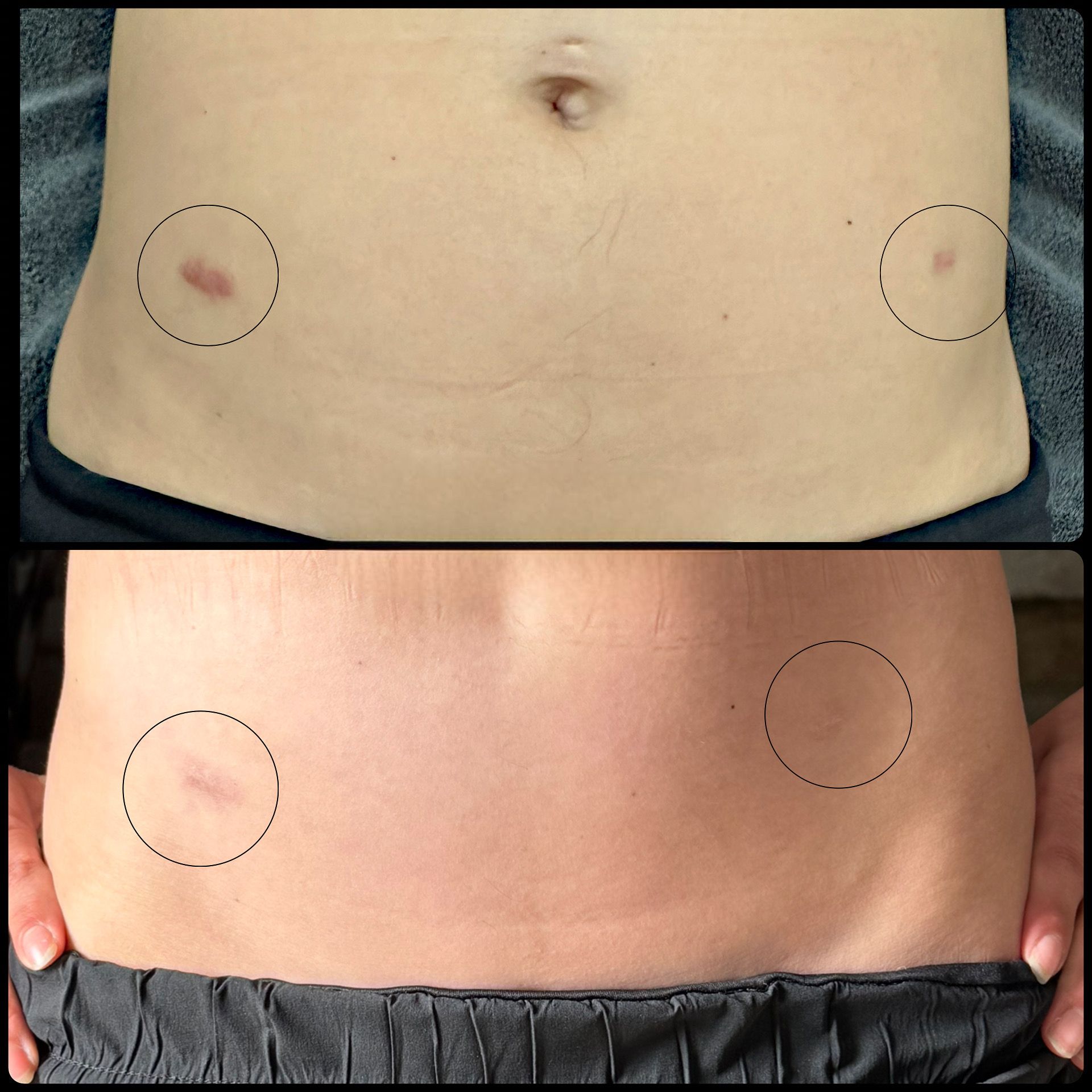 Before-and-after abdomen photos with marked skin spots circled on the left and right sides