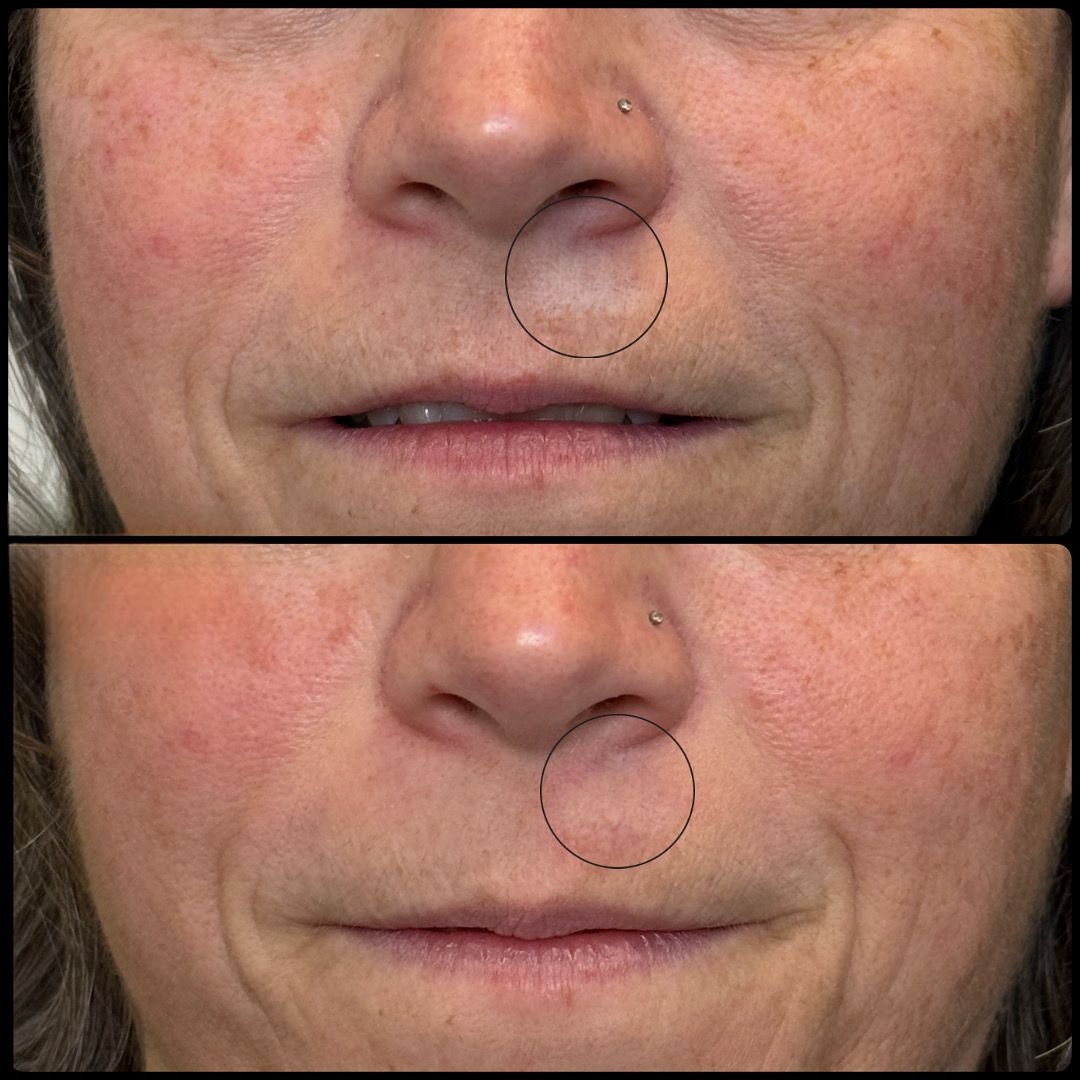 Close-up of a face with a dotted circle marking the right cheek, shown in two stacked before-and-after views