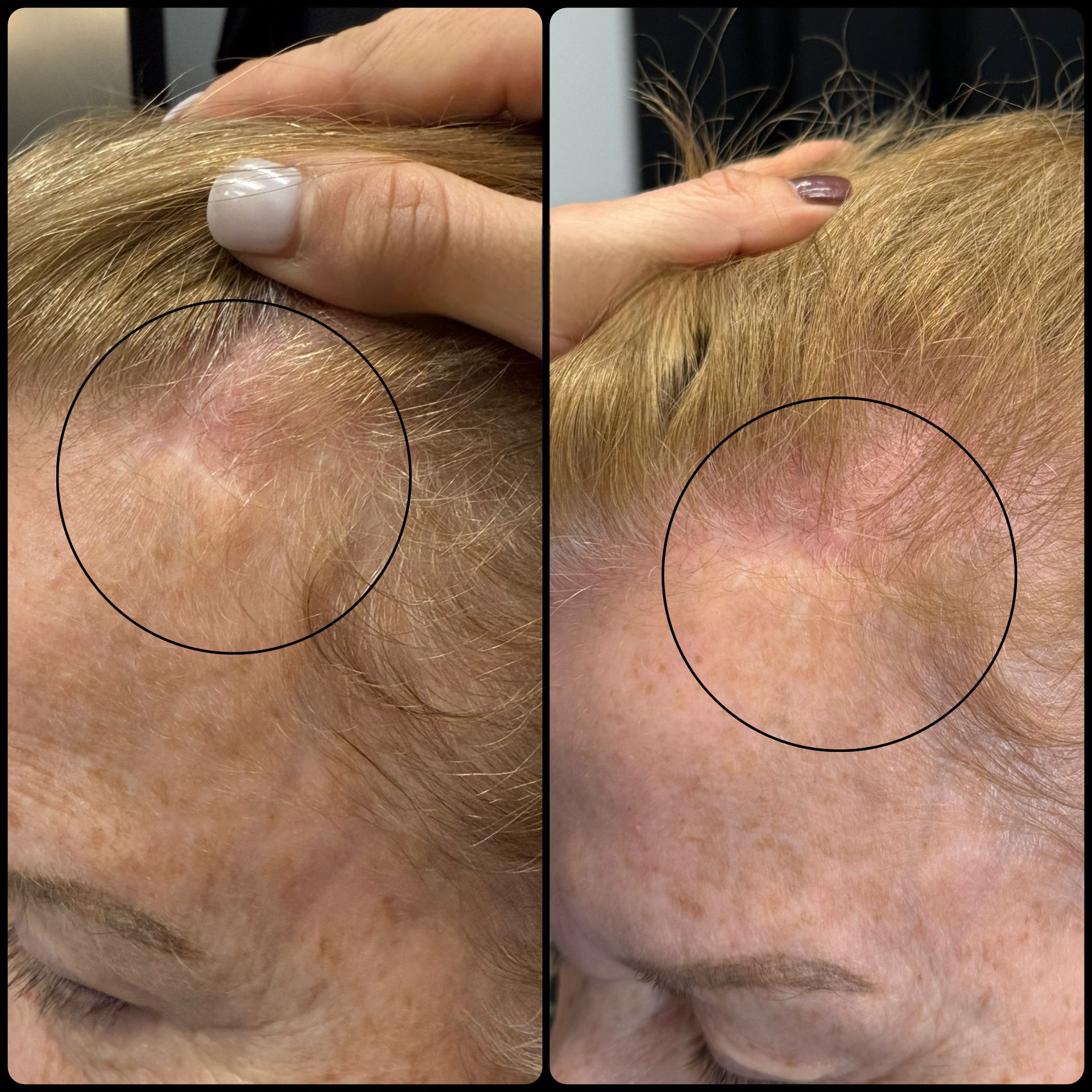 Split image of a scalp hairline with a circled pink, thinning patch being examined by a hand