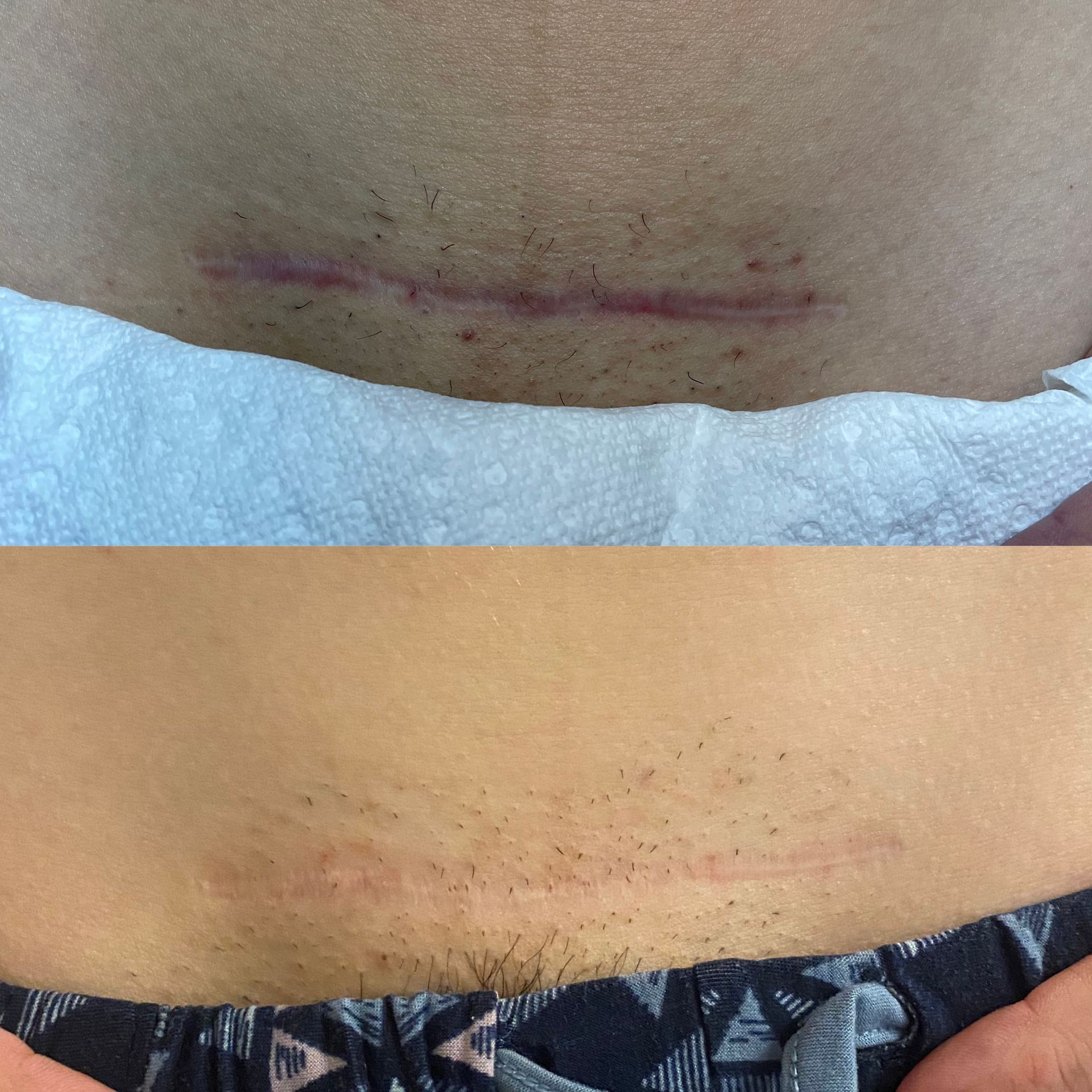 Two close-up abdominal skin photos showing a faint horizontal pink scar above a waistband and tissue