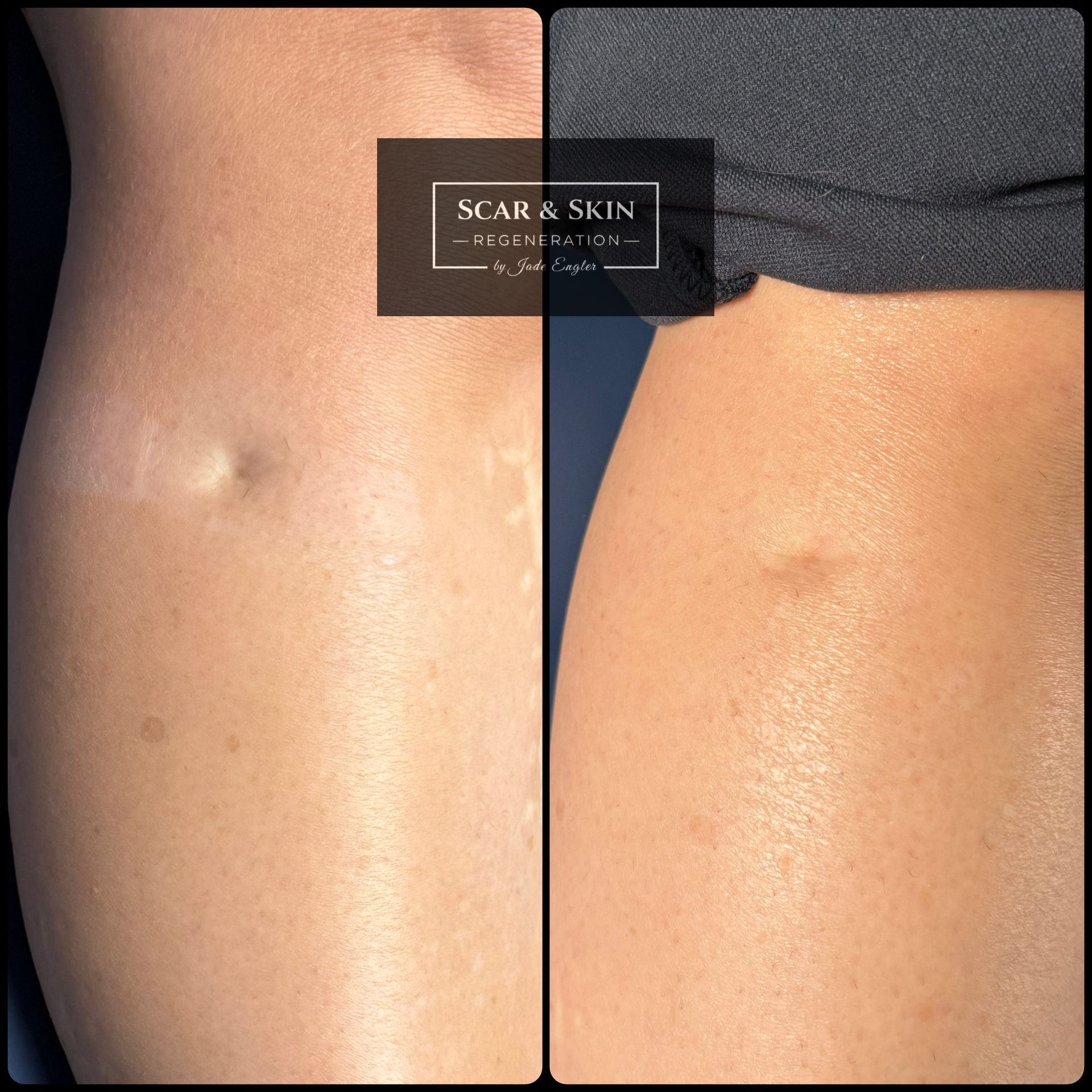 Side-by-side close-up of skin before and after, showing a reduced scar on the thigh.