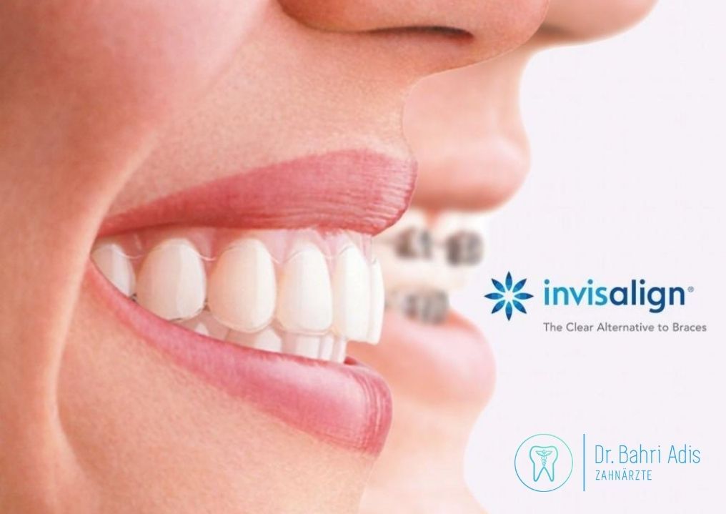 Das Lächeln einer Frau zeigt Invisalign-Aligner und herkömmliche Zahnspangen nebeneinander.