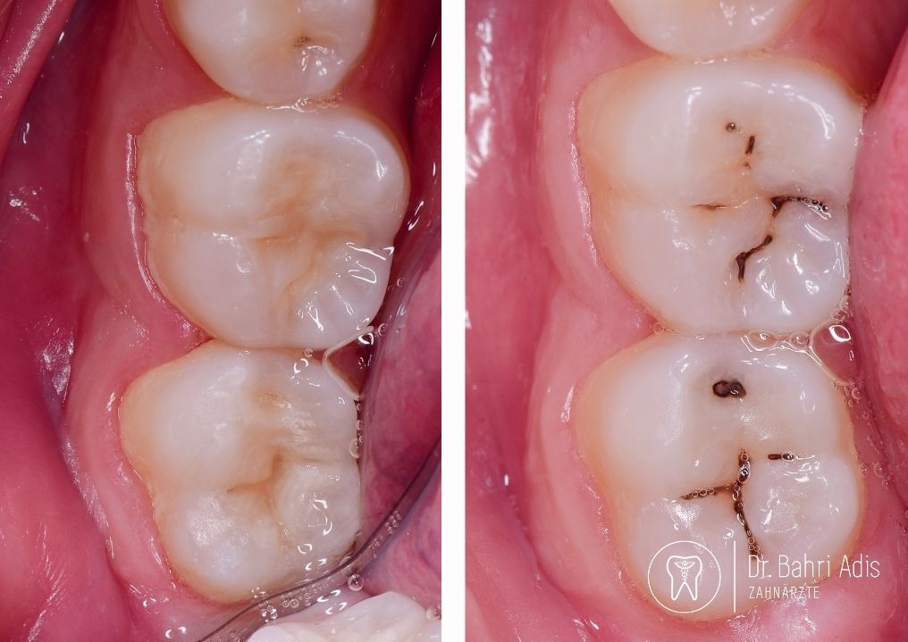 Two dental views showing upper molars with cavities before and after filling.