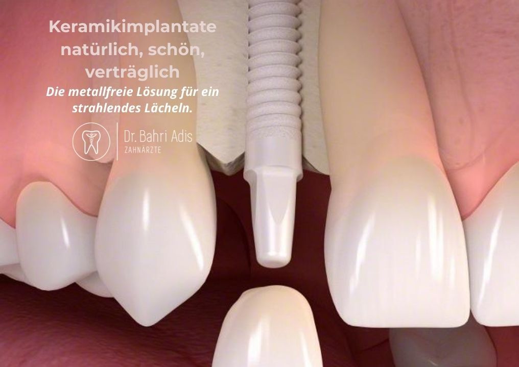 Zahnimplantat mit keramischen Werkstoffen, zeigt einen Zahnersatz für ein strahlendes Lächeln.