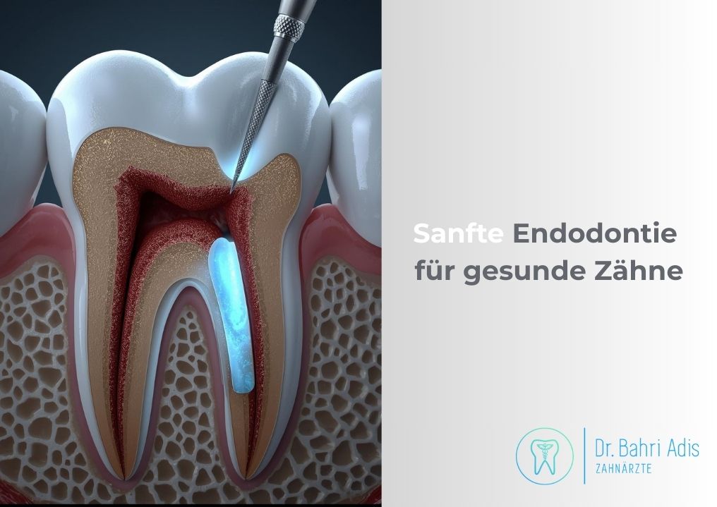 Abbildung eines Zahns während einer Wurzelkanalbehandlung mit dem Text: „Sanfte Endodontie für gesunde Zähne.“