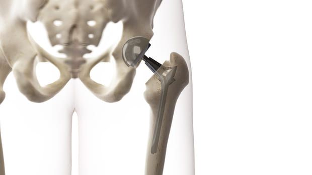 recohnised supplier of hip surgery after care