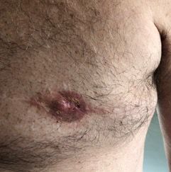 Areola restoration