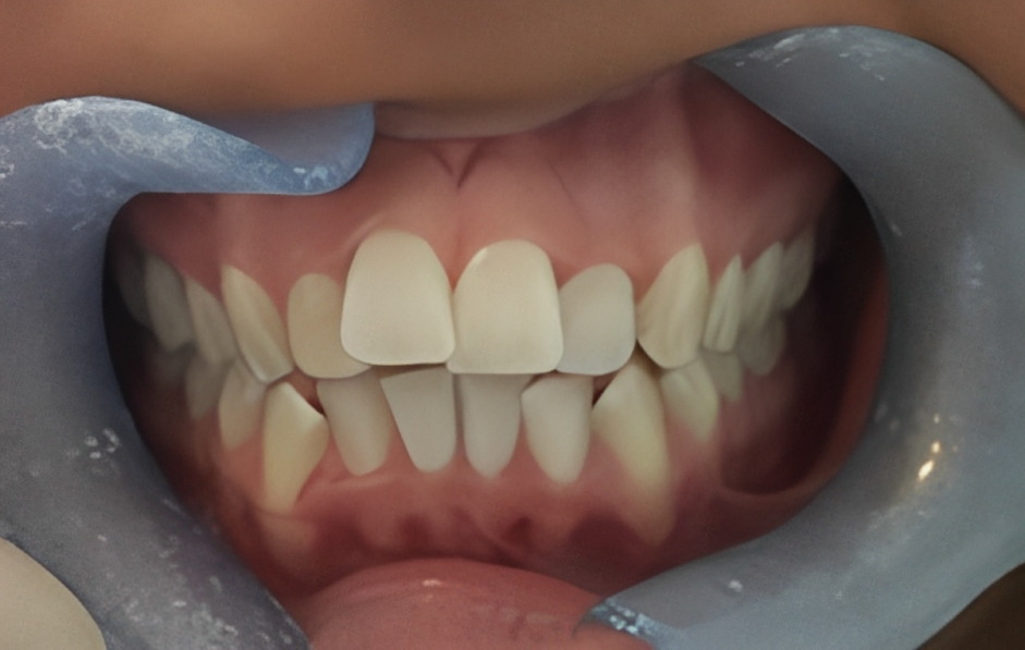improper teeth alignment
