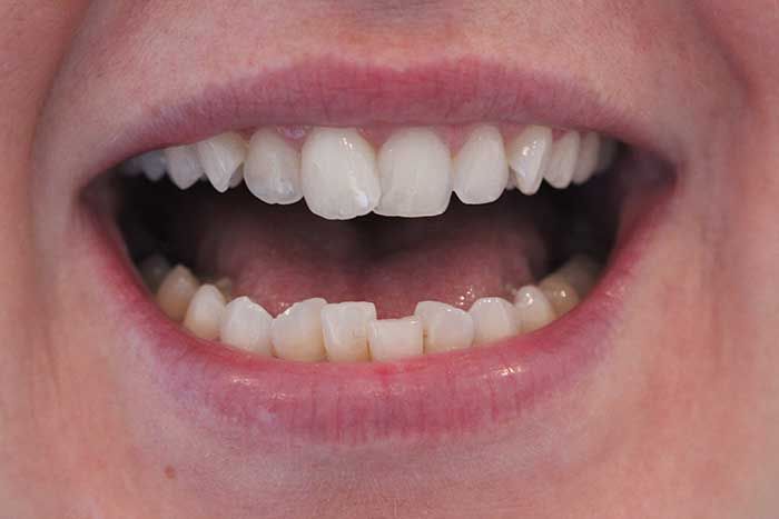 improper teeth
