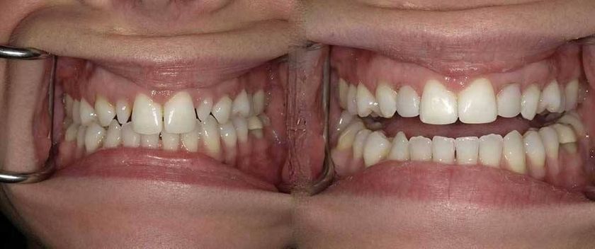 teeth clipping