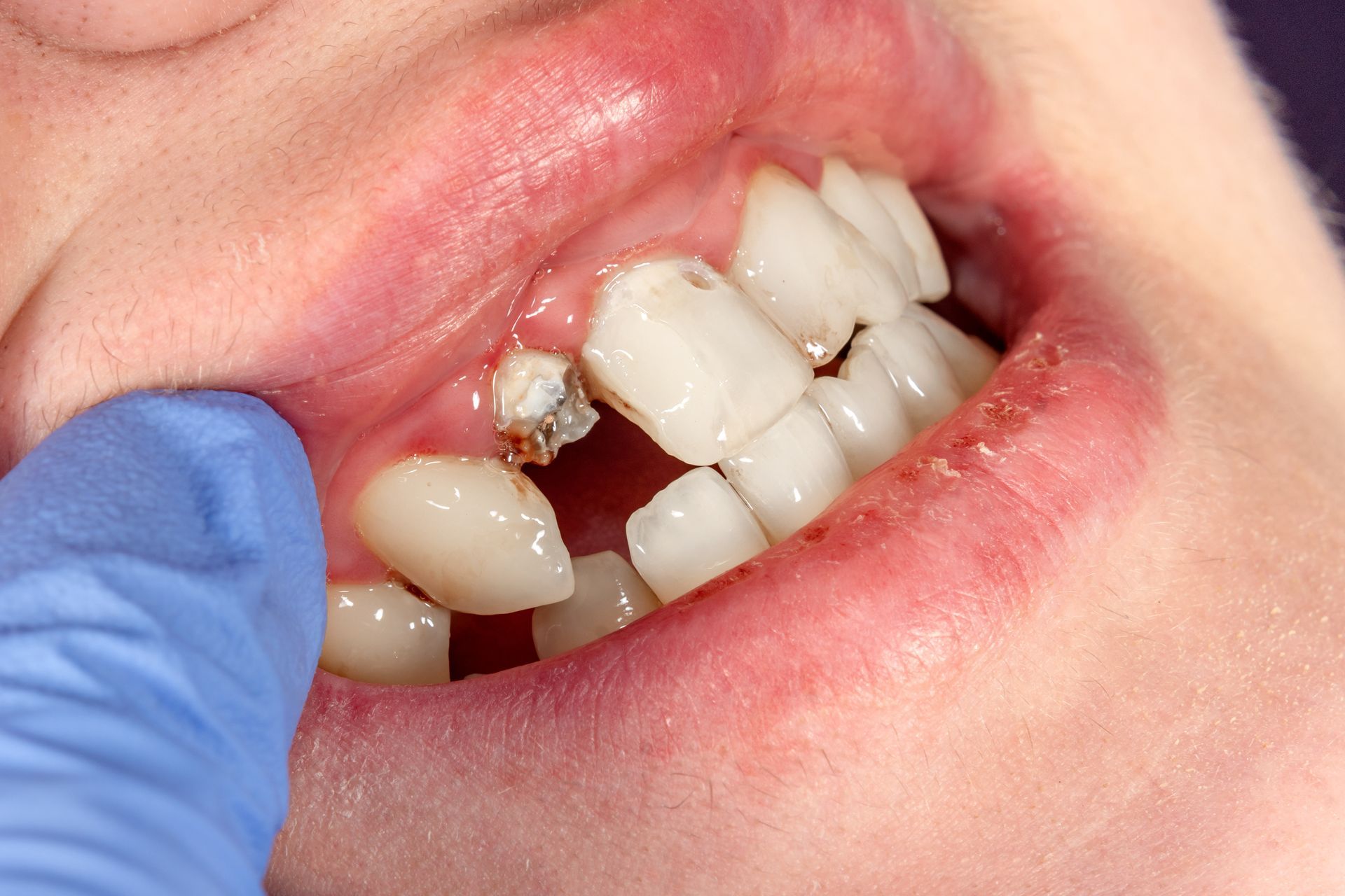 dental bridge