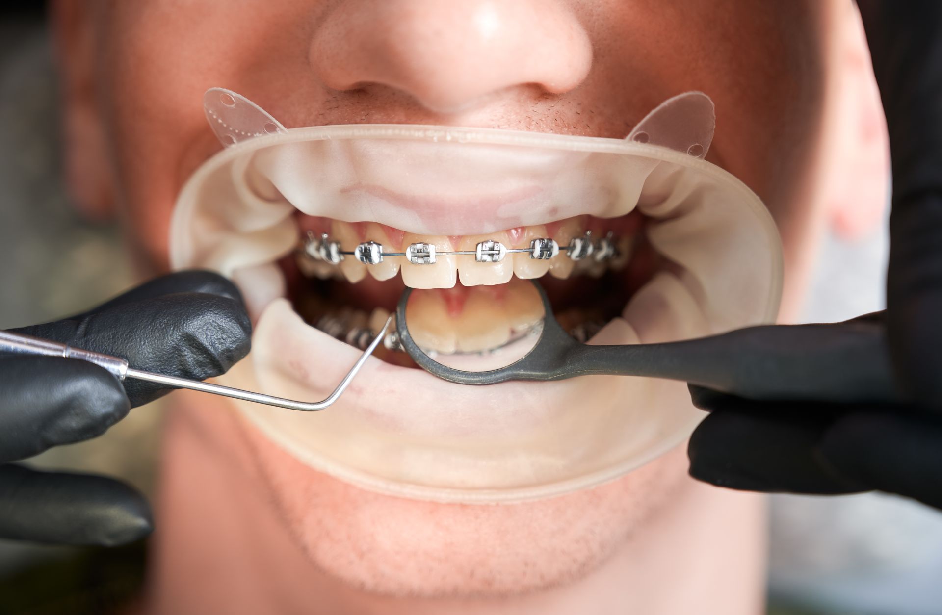 teeth clipping