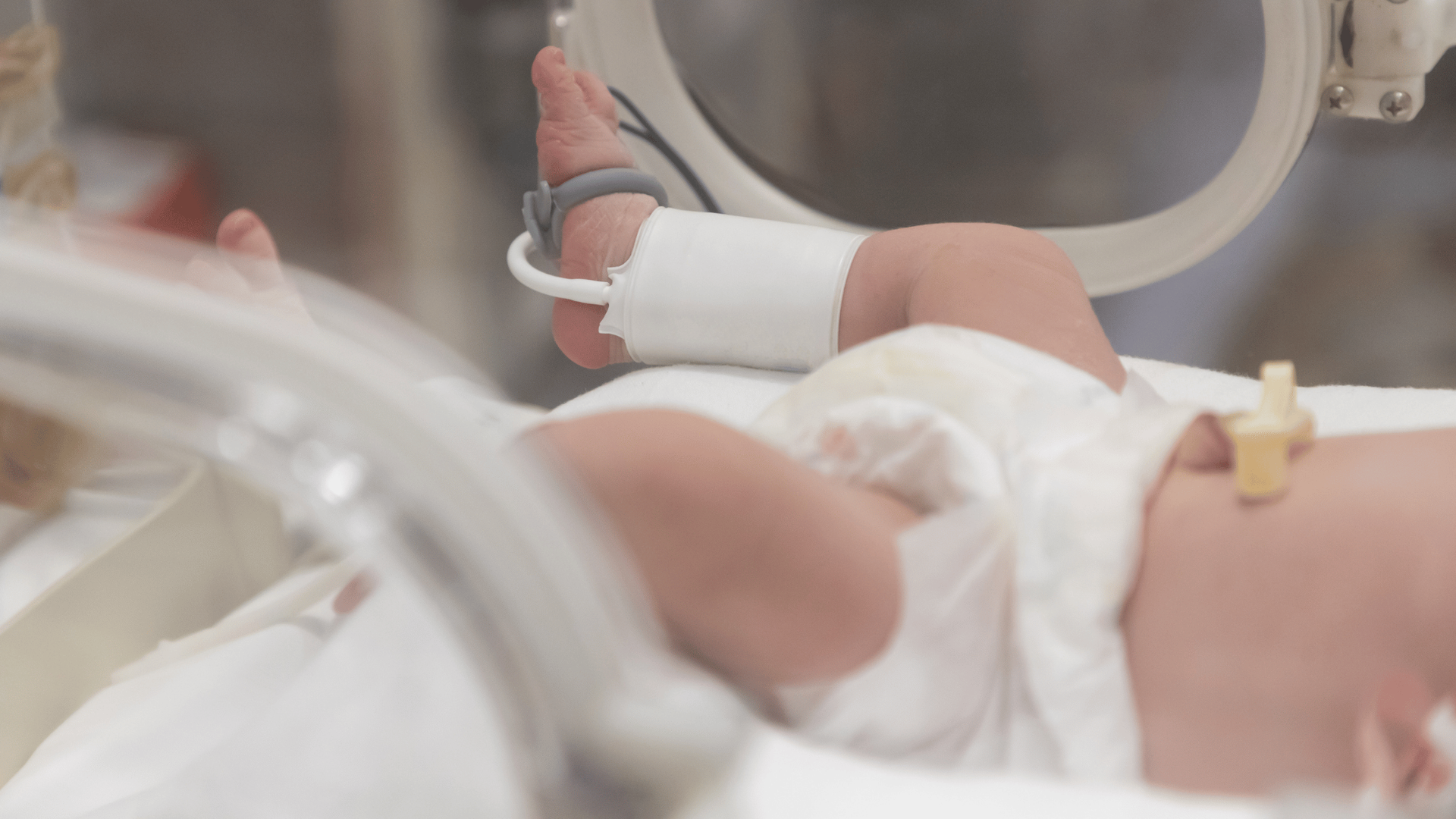 Newborn in a NICU incubator, with monitoring leads and medical tubing visible.