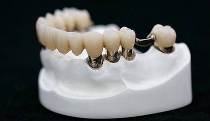 Implant Restoration