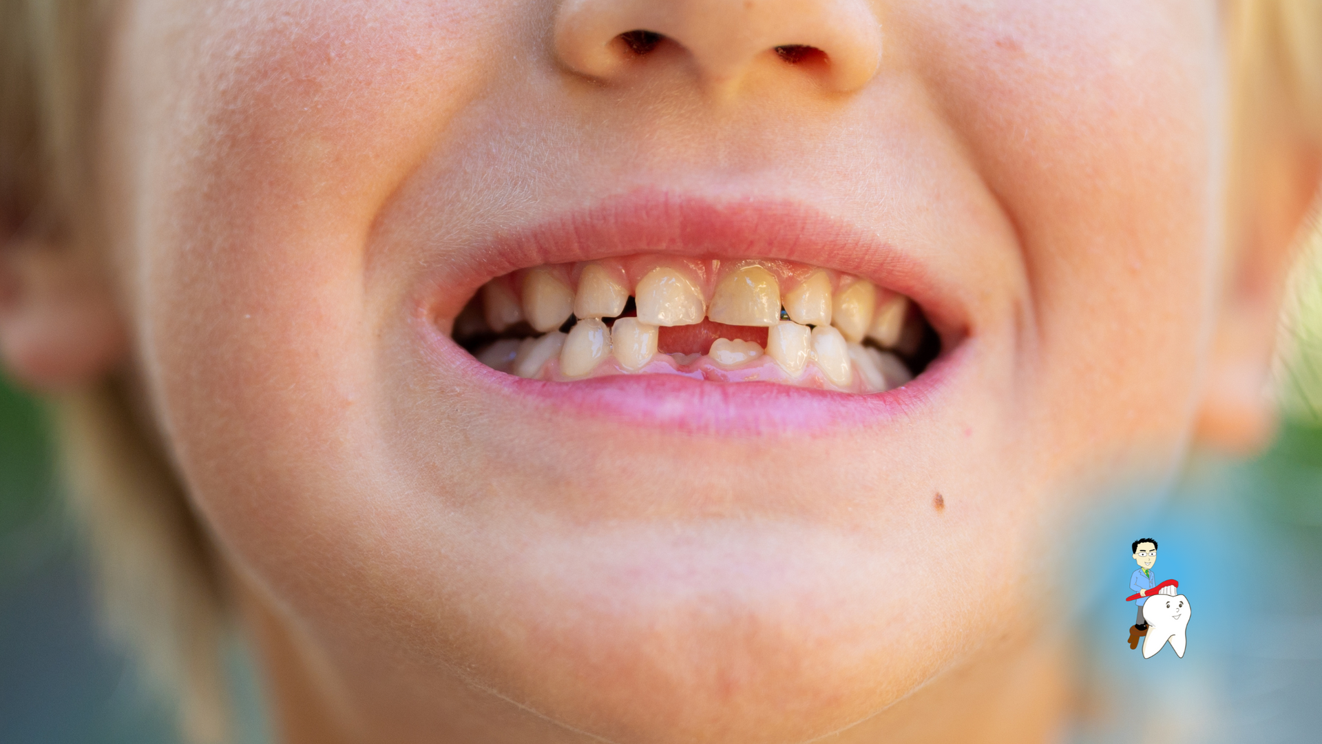 Close-up of a smiling mouth with uneven teeth and a small dental graphic in the corner