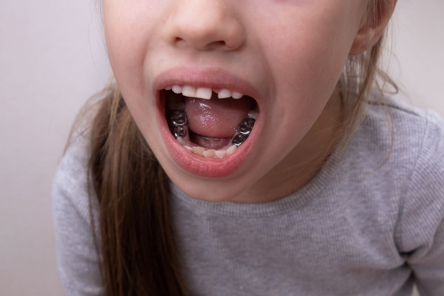 Close-up of a child with mouth open, showing silver braces and a gray shirt