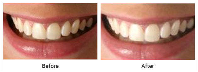 Teeth Whitening