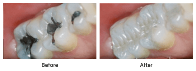Aesthetic Fillings