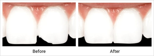 Cosmetic Bonding