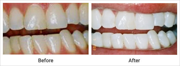 Teeth Whitening