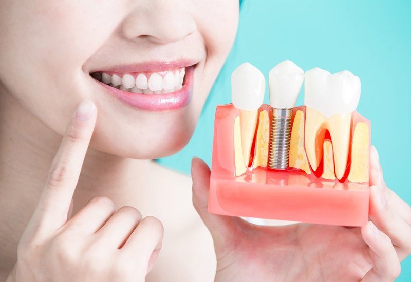 Dental Implants