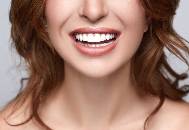 Veneers & Laminates