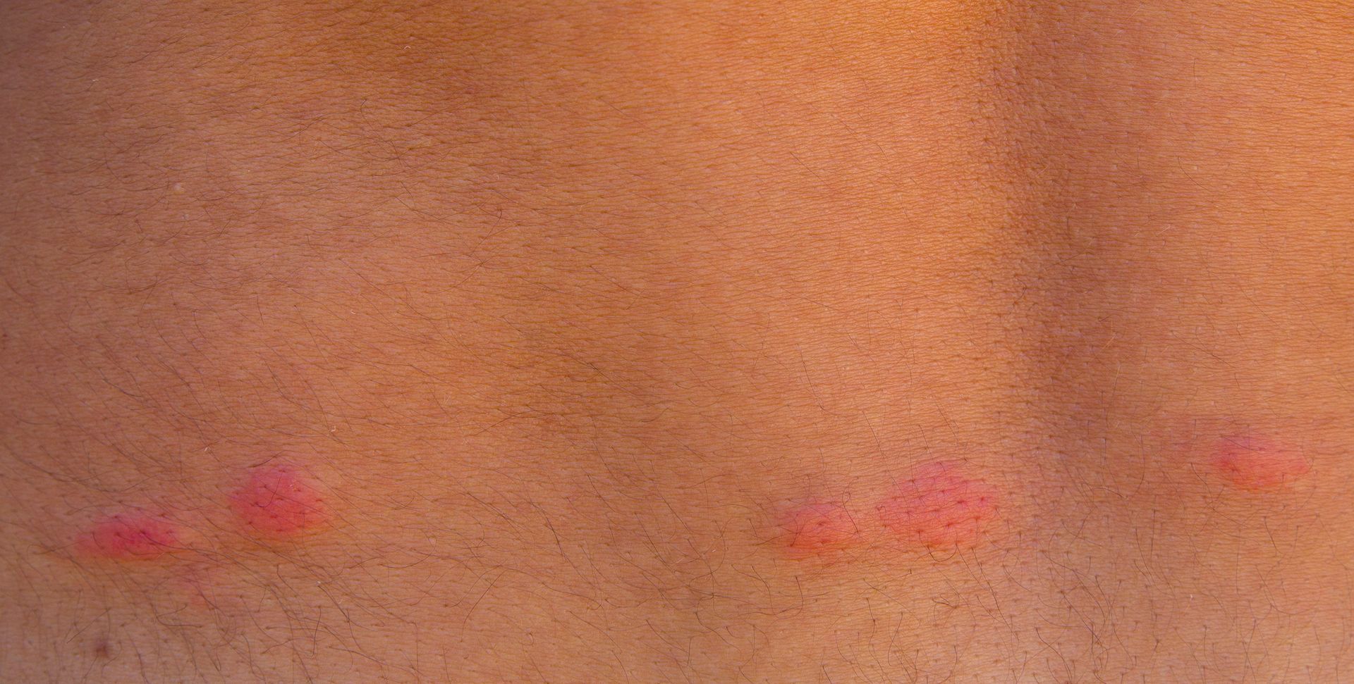 flea bites