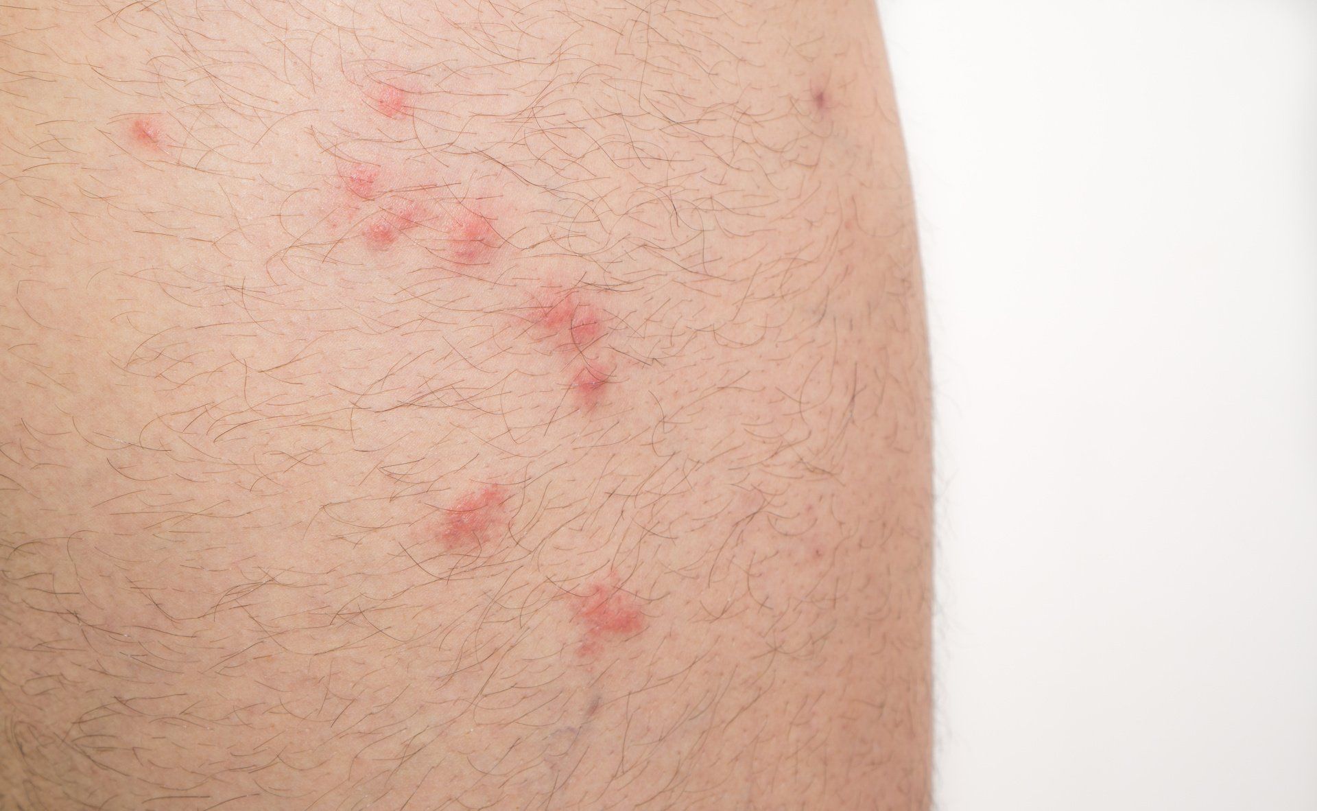 image of flea bites