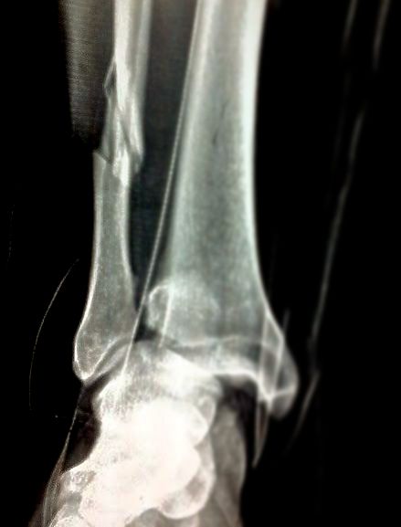 Traumatología Tobillo y Pie, servicio de patología de tobillo y pie.