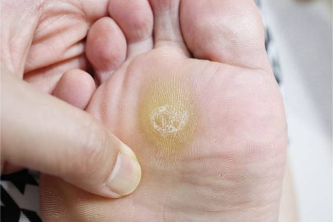 Corns and calluses