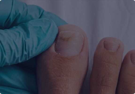 Damaged and Thickened Nails