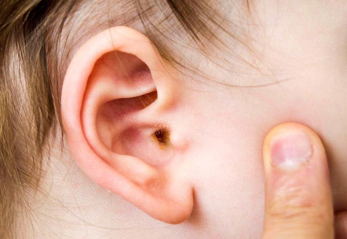 Ear wax removal