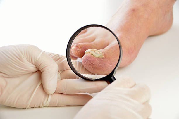 Fungal nails