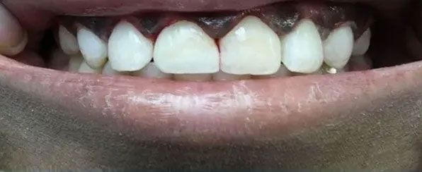 Close-up of a person's mouth with visible teeth, lips, and part of the cheek. Teeth are white and the lips are slightly pink.
