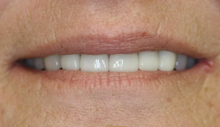 Close-up of a person's mouth with a full set of bright, white teeth visible in a slight smile.